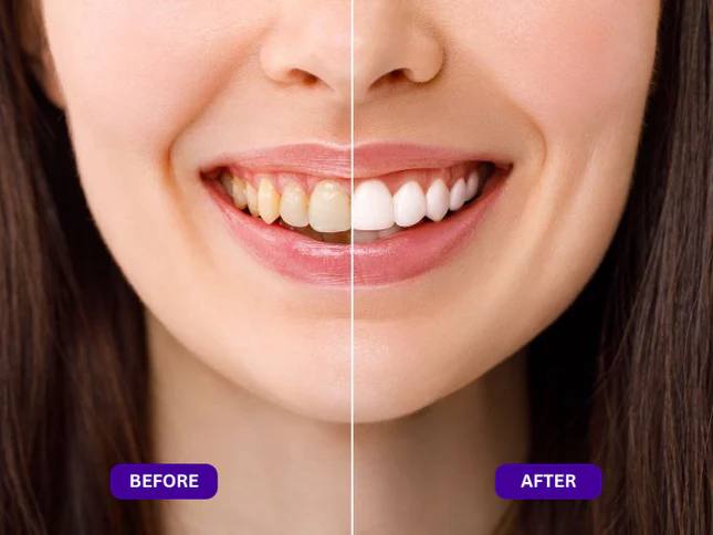 Arconism™ Purple Teeth Whitening Strips